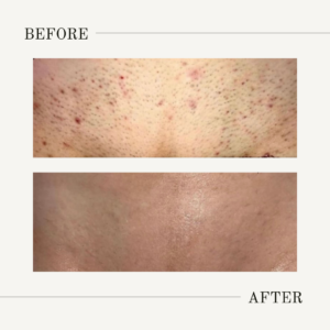 bikini laser hair removal treatment