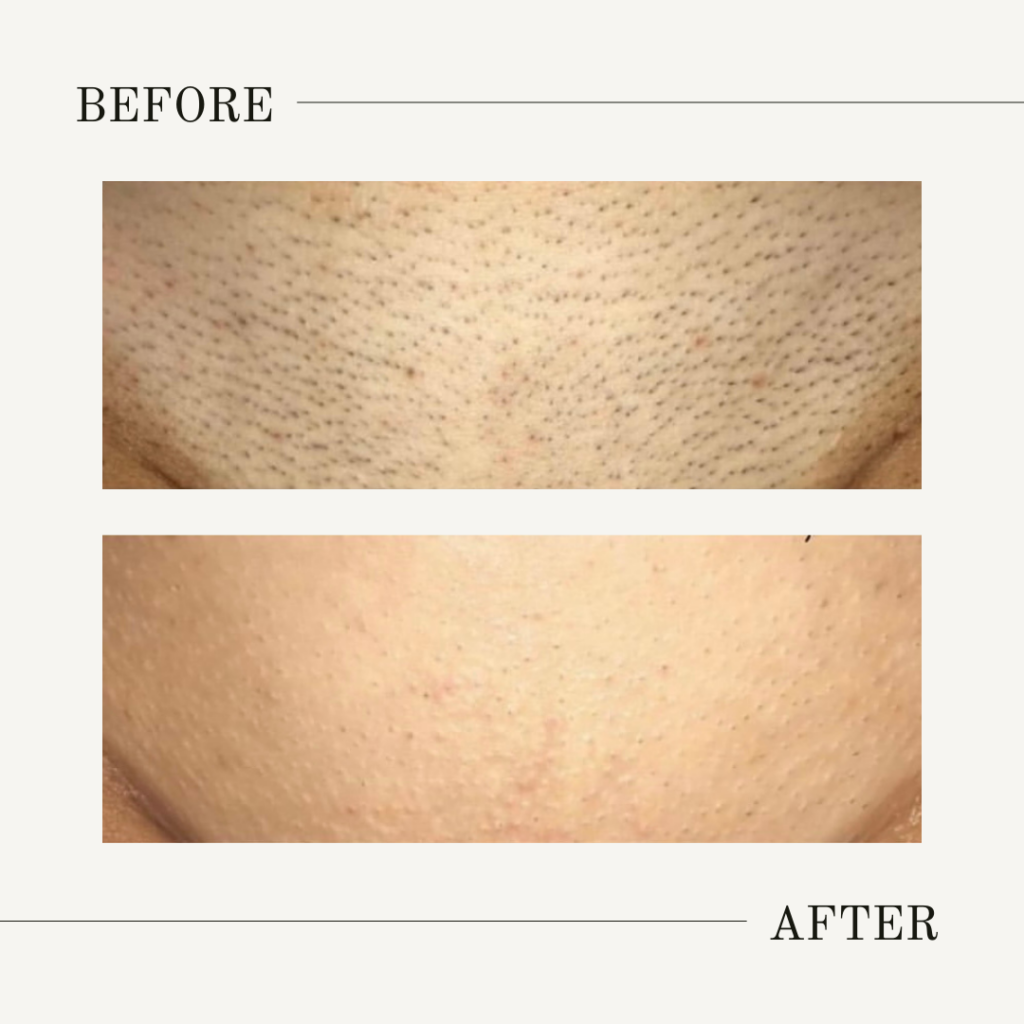 brazilian hair removal treatment