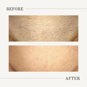 brazilian hair removal treatment