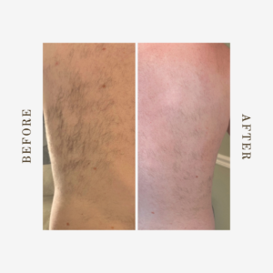 permanent back hair removal