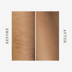 arm laser hair removal