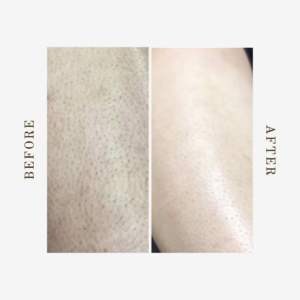 legs hair removal service