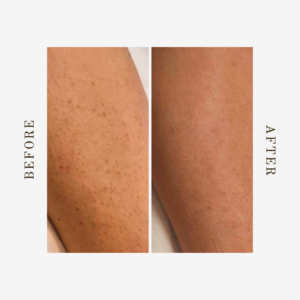 laser hair removal full legs