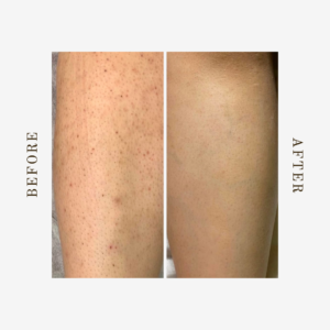 full leg laser hair removal cost