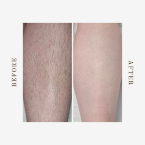 best laser hair removal for legs