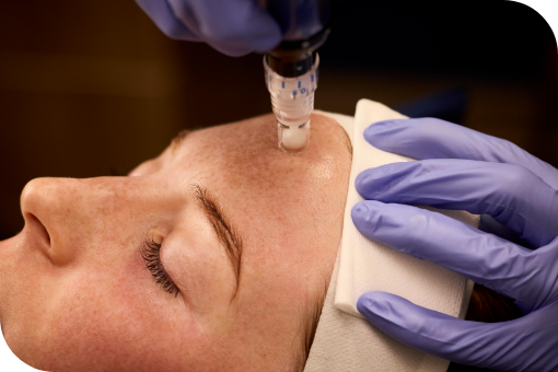 Microneedling 1