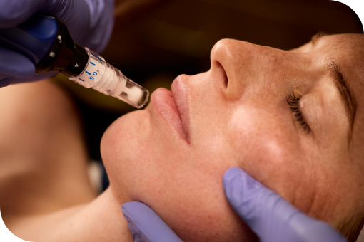 Microneedling 2