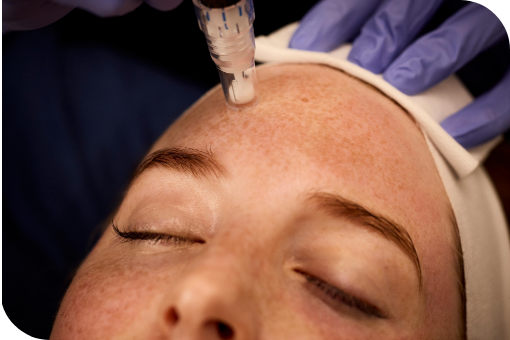 Microneedling 3