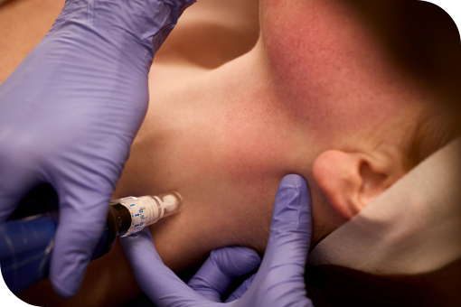 Microneedling 4